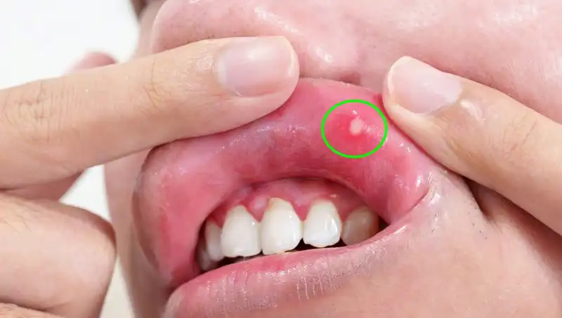 Vücudunuzdaki B Vitamini Eksikliğini Gösteren 5 Kesin Belirti