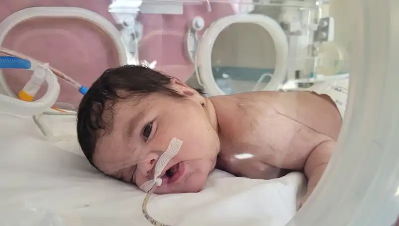 34 Haftalık Eymen Bebek Eşsiz Bir Başarıyla Hayata Tutundu