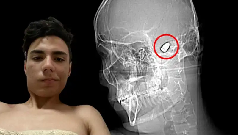 Kafasında Patlayıcı Bomba Taşıyan Genç Adamın Korkunç Hikayesi