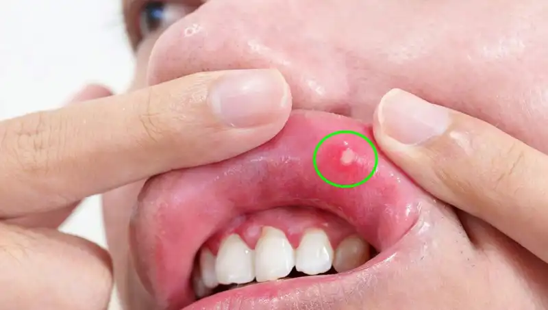 Kanser Belirtilerini Göz Ardı Eden Genç Kadının Trajik Hikayesi